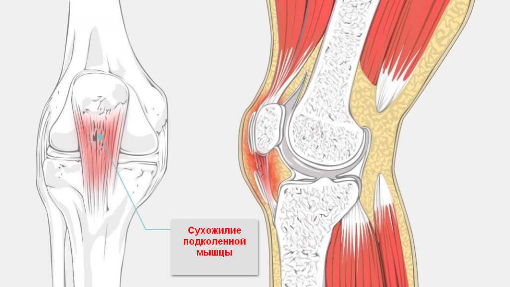 Подколенное сухожилие фото