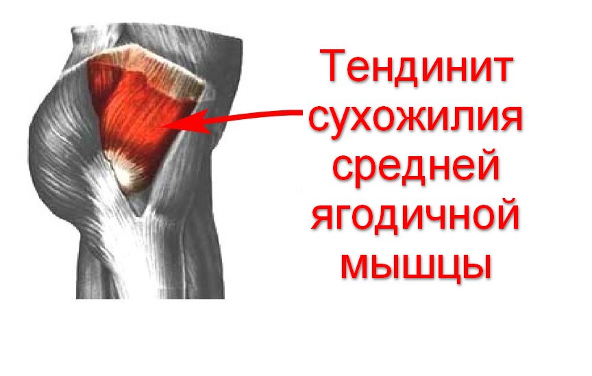 Сухожилие средней ягодичной мышцы. Тендинит ягодичных мышц. Заболевание сухожилий. Тендинит приводящей мышцы. Сухожилие малой ягодичной мышцы.